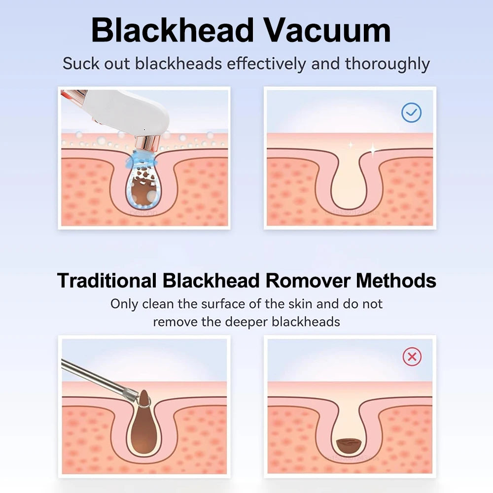 Peicon Electric Blackhead Remover Pore Vacuum – EMS Deep Cleansing | Rechargeable Facial Cleaner