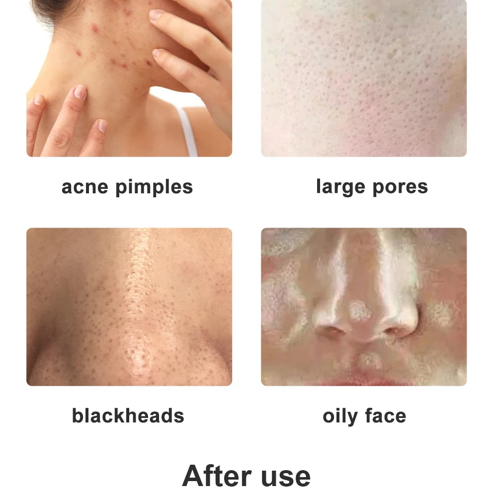 Diamond Tip Microdermabrasion Machine – 9-Head Vacuum Exfoliation & Spray Device