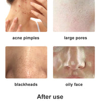 Diamond Tip Microdermabrasion Machine – 9-Head Vacuum Exfoliation & Spray Device