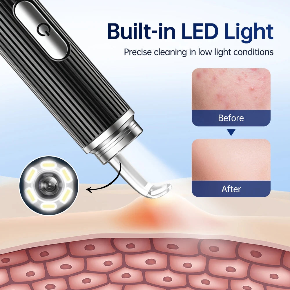 Hailicare Visual Blackhead Remover – 50x HD Camera, Wi-Fi App & LED Light | Acne Pore Cleaner Kit