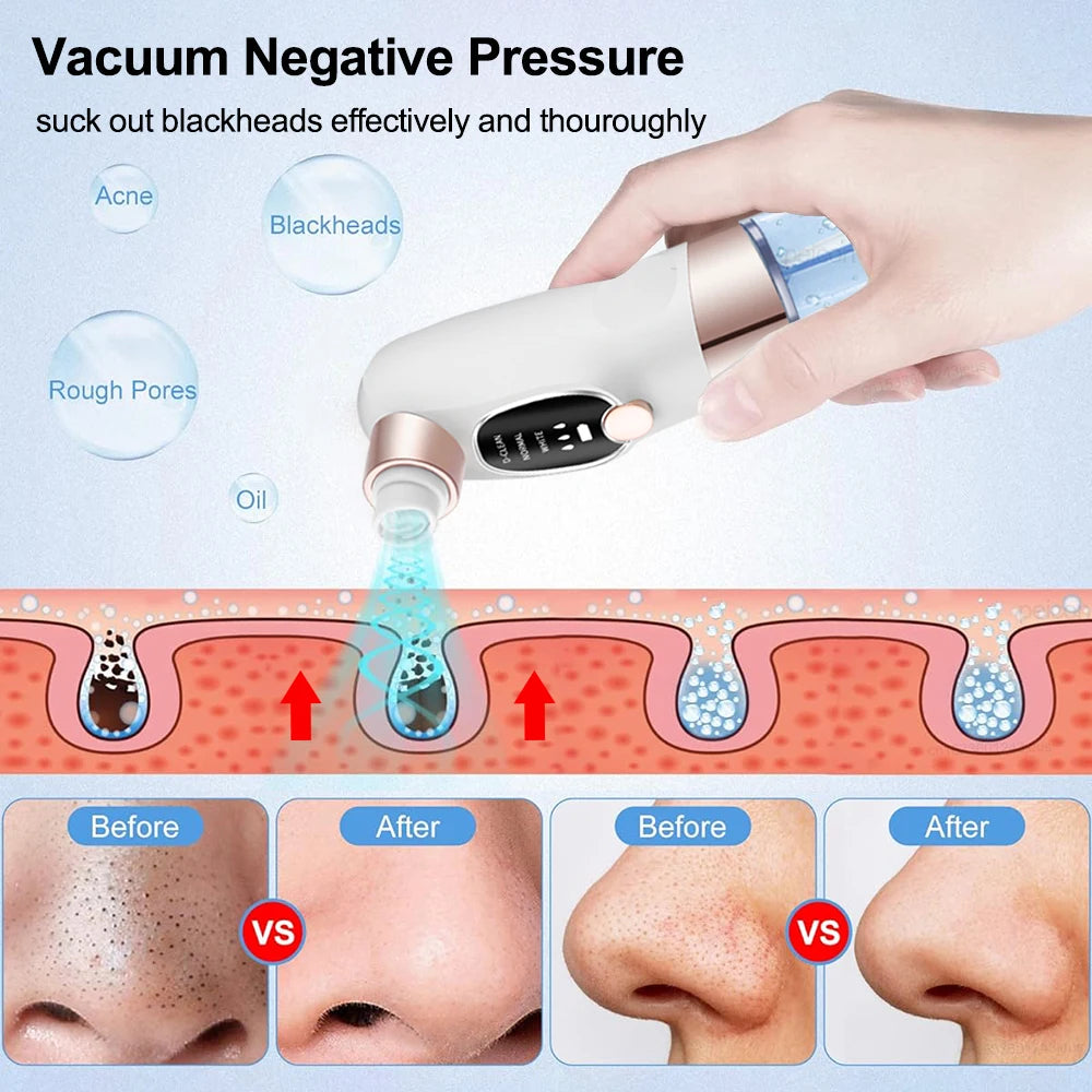 Peicon Electric Blackhead Remover Pore Vacuum – EMS Deep Cleansing | Rechargeable Facial Cleaner