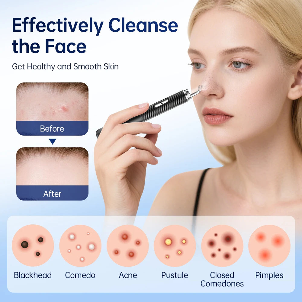 Hailicare Visual Blackhead Remover – 50x HD Camera, Wi-Fi App & LED Light | Acne Pore Cleaner Kit