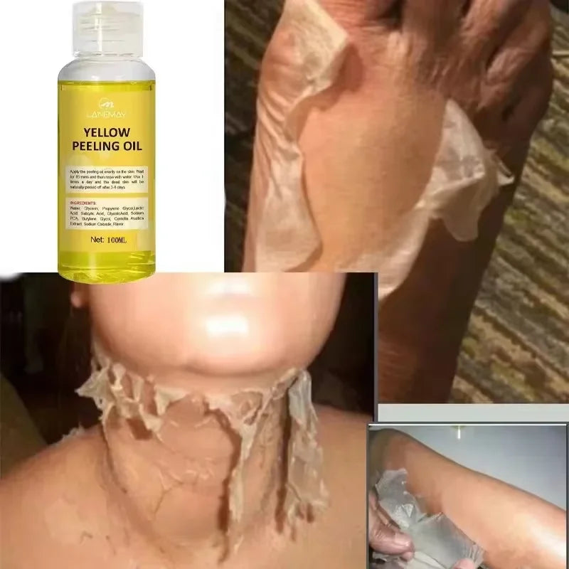 EELHOE Yellow Peeling Oil – Exfoliating Body Serum for Dark Spots, Knees, Elbows & Uneven Skin Tone (30ml / 50ml / 100ml)