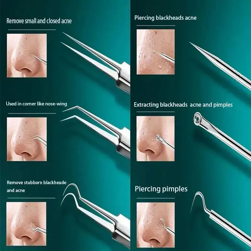 11-Piece Blackhead & Ingrown Hair Removal Tool Set – Acne Needles, Pore Cleaner & Tweezers Kit