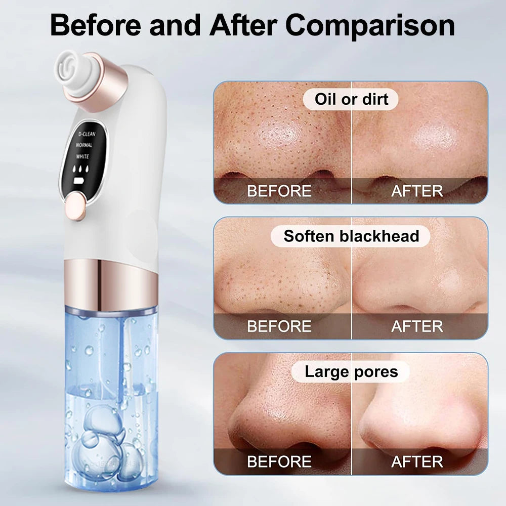 Peicon Electric Blackhead Remover Pore Vacuum – EMS Deep Cleansing | Rechargeable Facial Cleaner