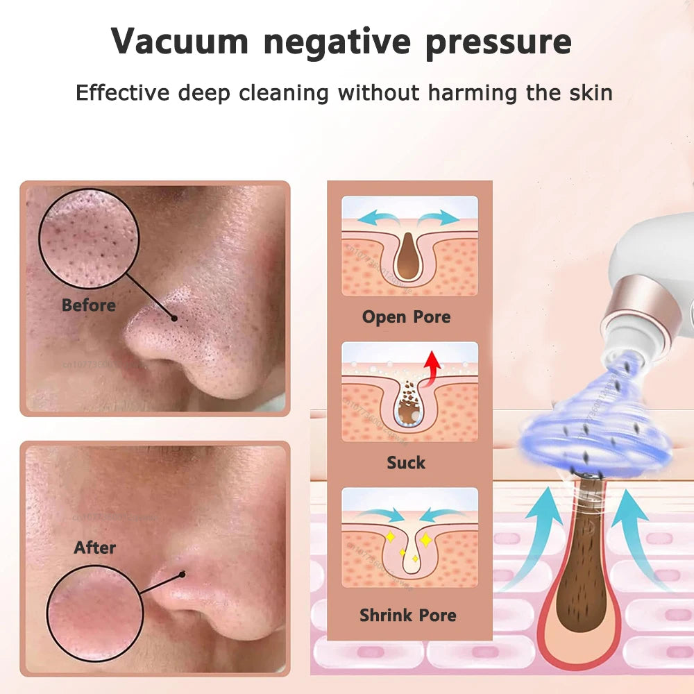BXA Electric Blackhead Remover Pore Vacuum – Water Cycle Deep Cleansing | USB Rechargeable